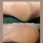 Oliveda cracked heel before and after